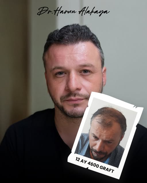 or many individuals struggling with hair loss, one of the most effective and long-lasting solutions 