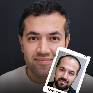 Hair loss affects not only appearance but also self-confidence. A high-quality hair transplant perfo