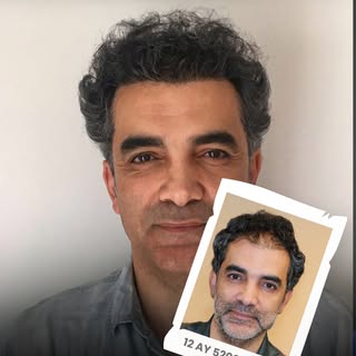 Hair transplantation is not only an aesthetic procedure; it is a permanent and natural solution that