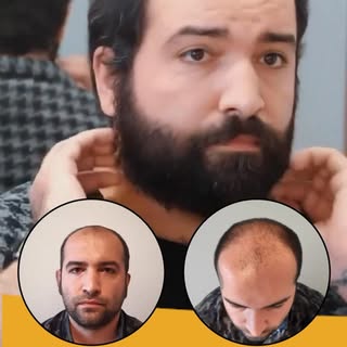 Hair transplantation is not only an aesthetic procedure; it is a permanent and natural solution that