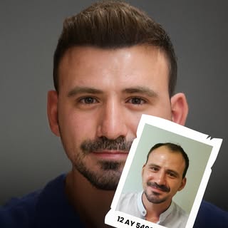 Hair loss affects not only appearance but also self-confidence. A high-quality hair transplant perfo