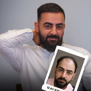 Hair transplantation is not only an aesthetic procedure; it is a permanent and natural solution that