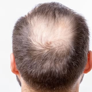 Transplants and Donor Hair: What You Need to Know

At The Hair Loss Recovery Program, we often get q