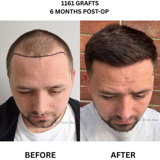 Hair transplants can look natural and virtually undetectable if well-executed. The goal isn’t just t