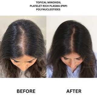 Yes, we treat females with hair loss too!

This patient had an amazing transformation after just 3 o