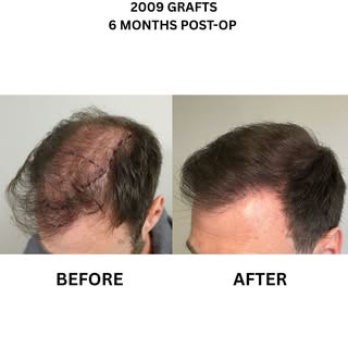 A fantastic result from @dr.ahmedriaz on this case 👏🏼

#hair #hairtransplant #hairtransplantuk #ha
