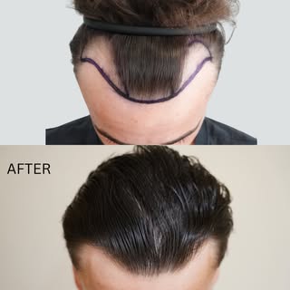This one deserves another post of its own.

Hair transplant result at 13 months post-op. 1999 grafts