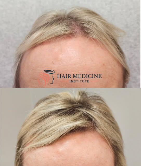 Before ➡️ 6 months after.
No procedures. No gimmicks. Just biology.
This is what consistent medical 
