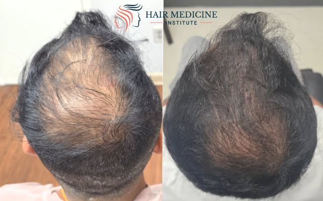 4 months ago he asked me for a hair transplant. I said, "Not yet."

His crown had thinned enough tha