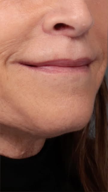 What if the secret to a more balanced lip wasn’t more volume?