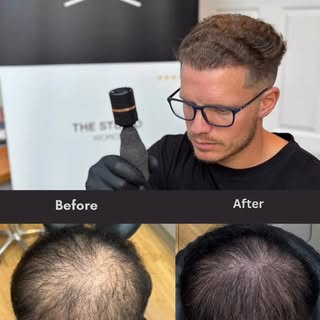 See how we quickly turned this thinning crown into a confident new look!?

From self-conscious to se