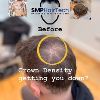 Crown Hair Density getting you down? 

Let’s talk about what can be done to fix your worries💬 

BLE