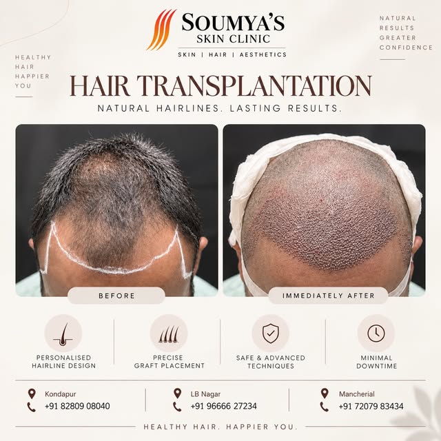 🌿 A new hairline begins with careful planning.

This case showcases the before and immediately post