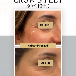 ✨ Crow’s feet are fine lines that commonly become more noticeable over time due to smiling and natur