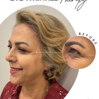 .
Your eyes can look refreshed — without looking different. ✨👁️💉

Crow’s feet and fine lines are a