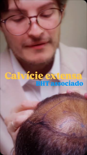 ✈️ De Miami 🇺🇸 para o Brasil 🇧🇷 para realizar o transplante capilar.

Hoje iniciamos um caso de 