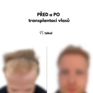 Když fotka „PŘED a PO“ nepotřebuje žádný filtr. 🔥

Zahoďte čelenky, čepice a neustálé maskování kou