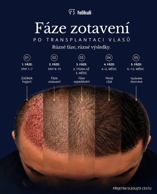 👉 Jak vypadá 12 měsíců po transplantaci vlasů?
Cesta k novému účesu je proces, který má svá jasná p