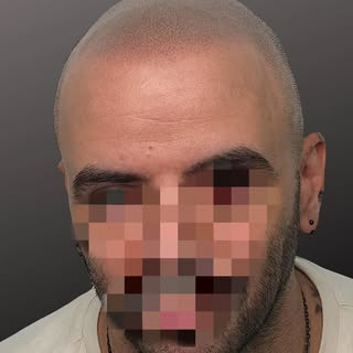 ✨ NO SOLO CAMBIAMOS SU IMAGEN. CAMBIAMOS CÓMO SE VE A SÍ MISMO.

Alopecia avanzada, nivel 7, y un ch