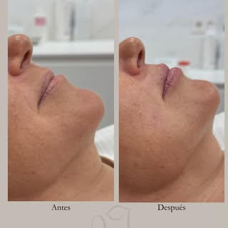 ¿Buscas un aumento de labios pero que sea natural? 👄

En este antes y después se aprecia una mejora