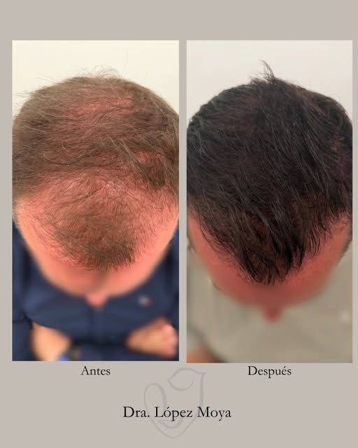 Caso capilar 💉

Caso clínico: 

Este paciente llegó a consulta con un problema de #densidadcapilar 