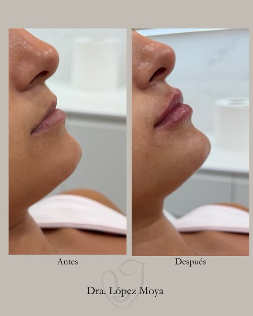 Hidratación de labios 👄

En este antes y después podemos observar como con #acidohialurónico hemos 