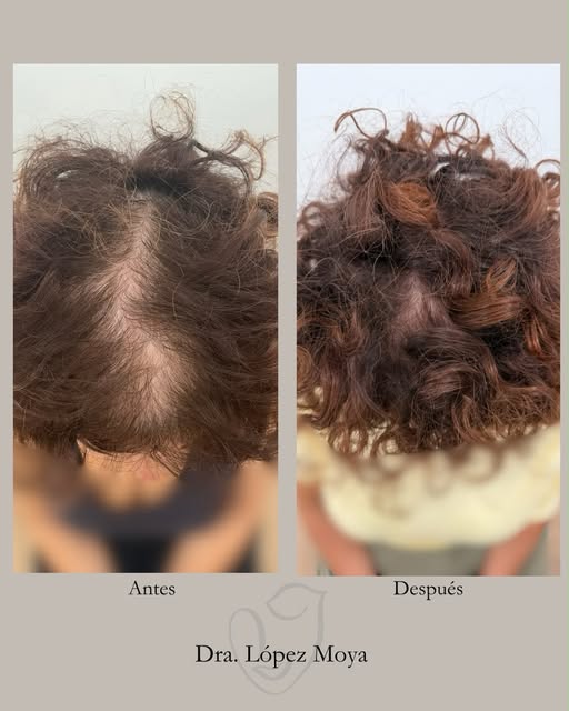 ¿Tu también has notado la pérdida de densidad capilar y tu cabello más fino? Esto te puede interesar