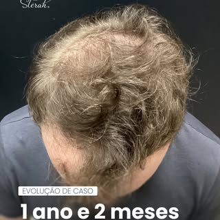 Luciano, 43 anos, de Porto Alegre, com 1 ano e dois meses de evolução do transplante capilar. Cada c