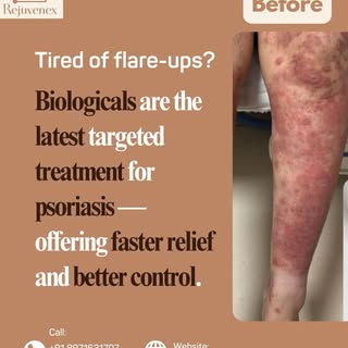 Struggling with stubborn psoriasis? There’s a better way to manage it.

Biologicals are advanced, ta