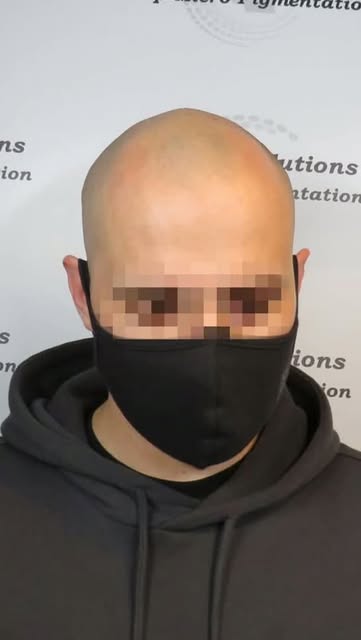 Scalp Micropigmentation hair tattooing at it's finest in Leicestershire.
Bringing the detail you des