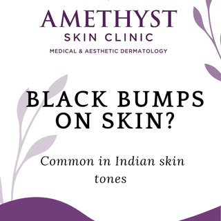 One of the most common things we see everyday is black little skin bumps. They all a look similar bu