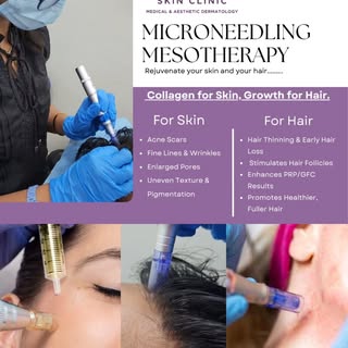 Tiny channels. Targeted results. ✨

Microneedling Mesotherapy creates microchannels in the skin and 