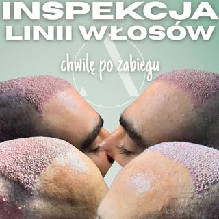 Cienkie włosy wyrastające pod ostrym kątem ze starannie selekcjonowanych wszczepów jednowłosowych. P