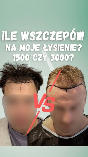Jaką ilość wszczepów/ graftów potrzebujesz aby uzyskać bdobre efekty? Posłuchaj co mamy do powiedzen