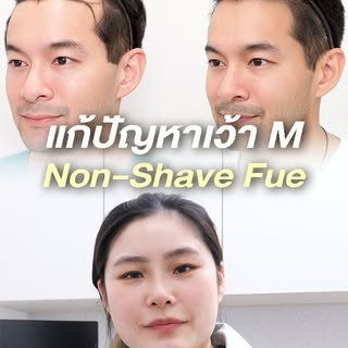 ปรับแนวไรผม แก้เว้า M คุณนิว เชื้ิอชาติ หลังปลูกแบบไม่โกนผม หรือ non shaven FUE 4 เดือน #fue #hairtr