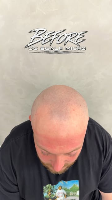 Restore your Hairline with SMP ⚡️
Before - After - Zoom 📈

𝗗𝗖 𝗦𝗖𝗔𝗟𝗣 𝗠𝗜𝗖𝗥𝗢 • 𝗤𝗨𝗔𝗟𝗜�