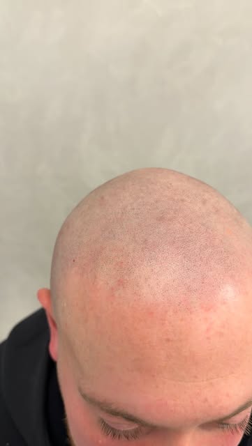 “REFRAME YOUR FACE”
With SMP only if you enjoy the shaved look 😮‍💨

𝗗𝗖 𝗦𝗖𝗔𝗟𝗣 𝗠𝗜𝗖𝗥𝗢 • �