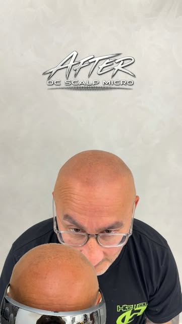 3 sessions from start to finish 👌🏽

This client had some sun damage to the scalp and definitely lo