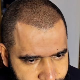 Disguise baldness with the Hair Follicle Micropigmentation – Hair-by-Hair Technique. A non-surgical 