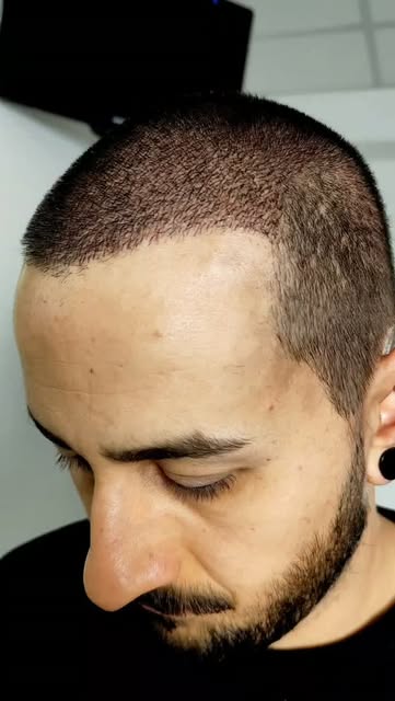 Cansado de esconder a calvície? 

A Micropigmentação Capilar Fio a Fio cria pontos e fios ultra real
