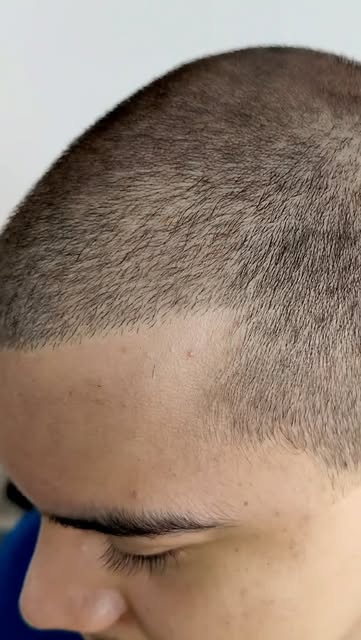 Ele era calvo!
Você sofre com a calvície? 
Essa técnica Revolucionária de Micropigmentação Capilar f