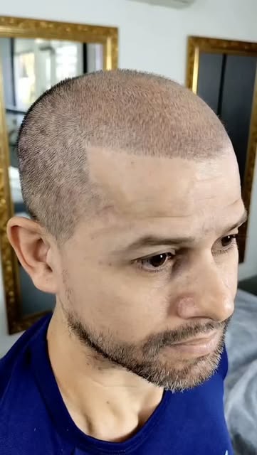 Você sofre com a calvície? 
A evolução da estética masculina com o procedimento de Micropigmentação 