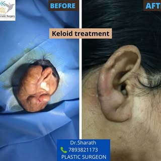 keloid Treatment by Dr.Sharath Chandra 
Contact 7893821173 for more details.