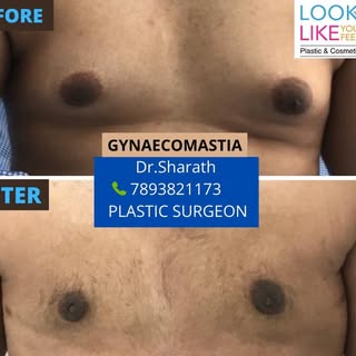 Gynacomastia treatment by  Dr.Sharath Chandra 
Before and After 
For more details contact +91 78938 