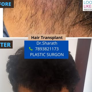 Get best results for hair transplantation by Dr.Sharath Chandra.
For more details call +91 78938 211