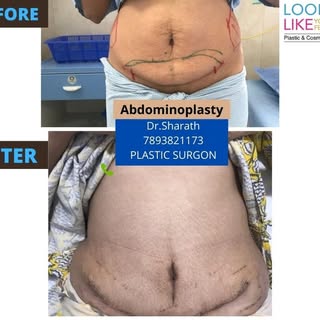 Abdominoplasty Treatment  by Dr.Sharath chandra
For more details contact 7893821173
.
.
.
#Hyderabad