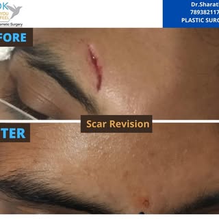 Scar Revision Treatment  by Dr.Sharath chandra
For more details contact 7893821173
.
.
.
#Hyderabad 
