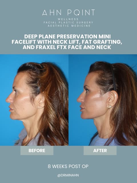 8 weeks post-op!

Andrea is now 8 weeks out from her Deep Plane Preservation Mini Facelift with Neck
