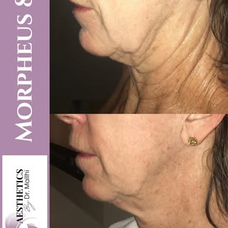 Lift, tighten, and smooth — all without surgery.

Morpheus8 uses radiofrequency microneedling to sti