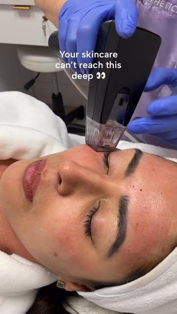 Morpheus8 is where microneedling meets radiofrequency energy ✨

By delivering RF energy beneath the 